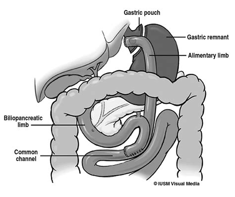 Roux En Y Gastric Bypass Afferent Limb