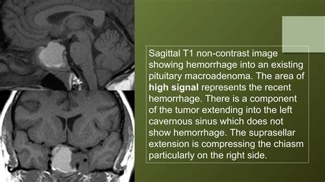 Pituitary gland MRI | PPTX