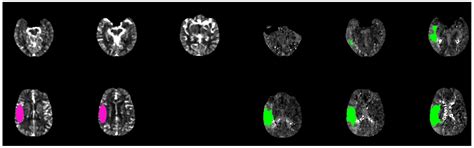 The Pathophysiology of Collateral Circulation in Acute Ischemic Stroke