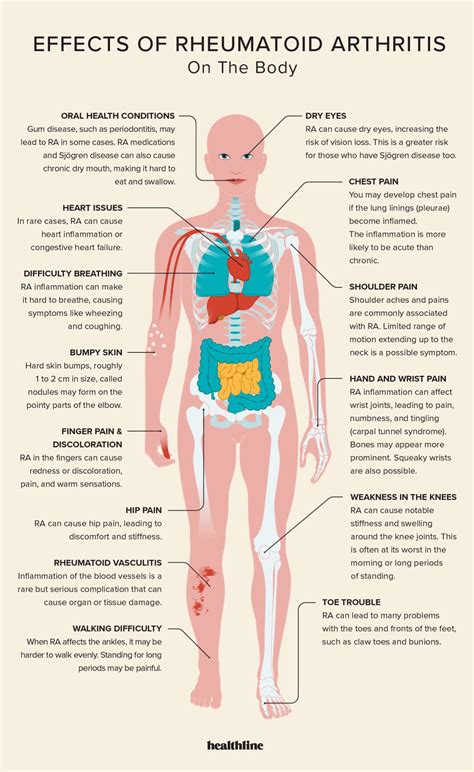 Rheumatoid Arthritis and its Treatments – Science Technology and Society a Student Led Exploration