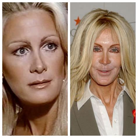 Joan Van Ark ..... What happened.....before and after | Celebrity plastic surgery, Summer ...