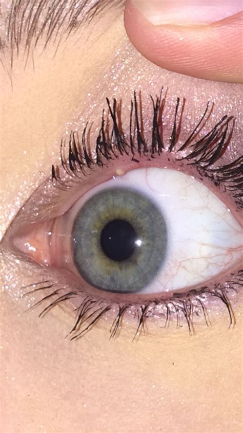 White Bump On Eyelid