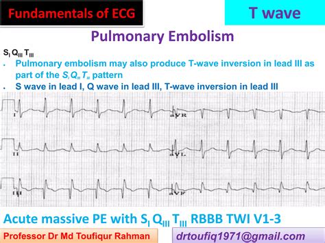 Approach to a patient with T wave abnormality in ECG | PPSX