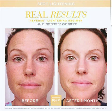 Does Retinol Help With Acne Scars