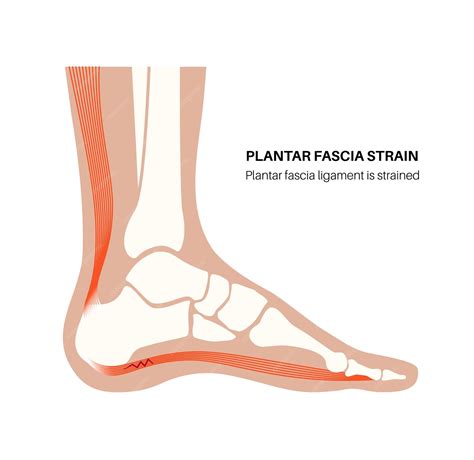 Premium Vector | Plantar fascia strain anatomical poster Tear of the soft tissue under the arch ...