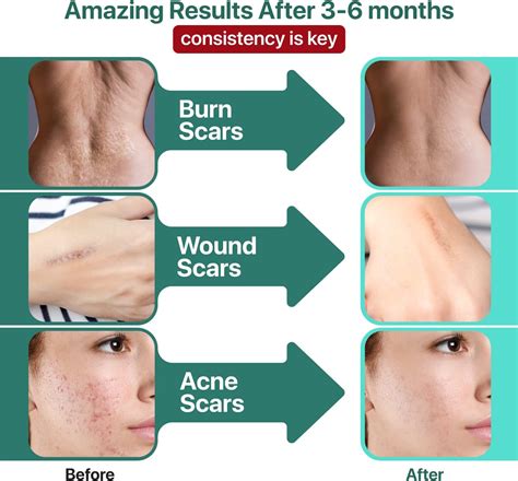 Buy Ebanel Bundle of Lidocaine Numbing Cream, and Advanced Silicone ...