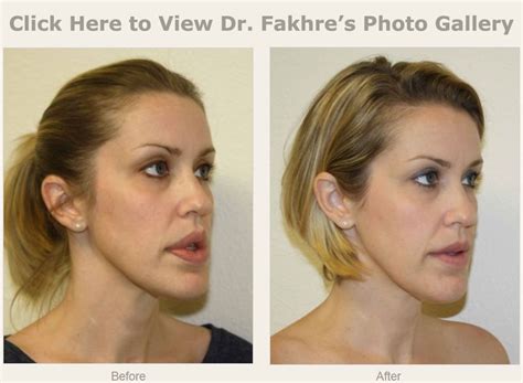 Bildergebnis für top+lip+surgeons