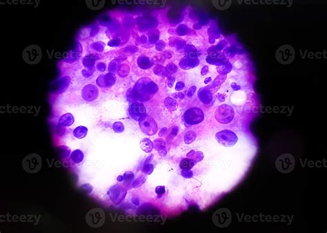 Cytological study of intra abdominal mass, Spindle cell sarcoma, positive for malignant cells ...