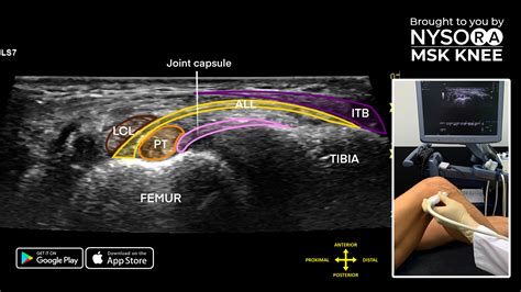 Iliotibial Band Ultrasound