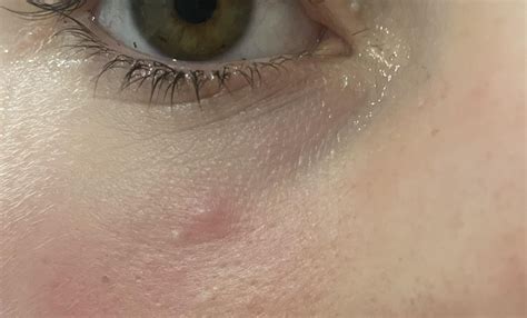 Small soft bump under eye : r/DermatologyQuestions