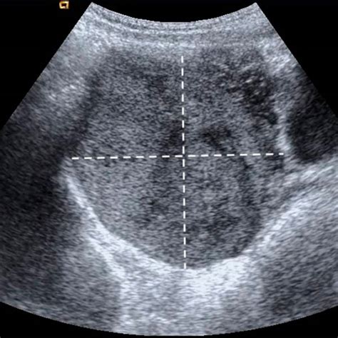 A rare case of testosterone-secreting ovarian tumor