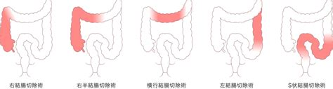 Image result for Invaded Loop Pattern