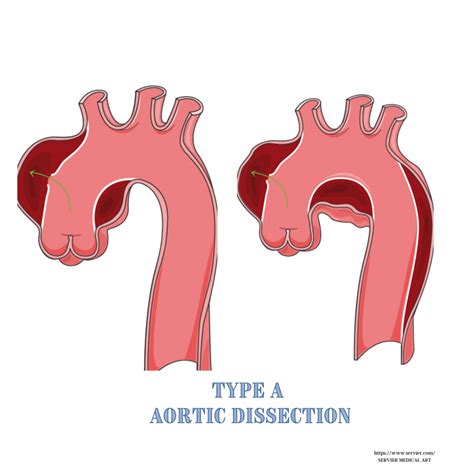Aortic Dissection – Vascular Info