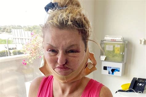 Danniella Westbrook is almost unrecognisable with painfully swollen face after undergoing MORE ...