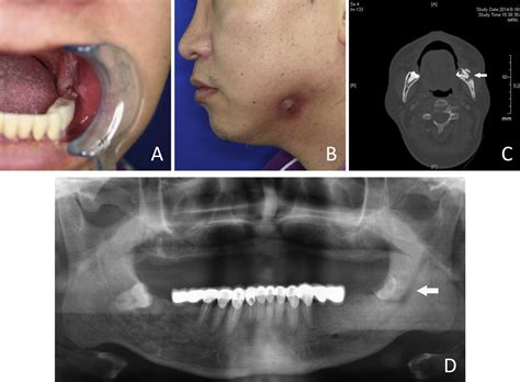 Osteoradionecrosis Of The Mandible: A Review – IDOCTJ