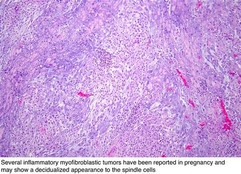 Spindle Cell Carcinoma Uterus at Justin Cabral blog