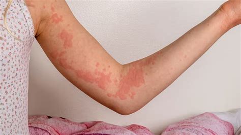 Unexplained Rash After Eating? It Could Be a Food Allergy – MyDiagnostics