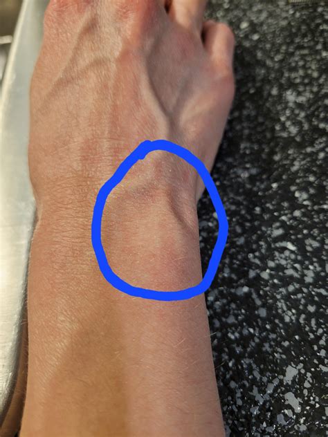 Burst Vein On Wrist