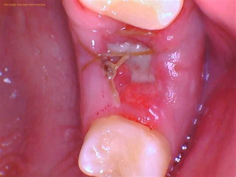 Image result for Stitches After Tooth Extraction