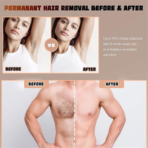 FREYARA IPL Laser Hair Removal Permanent at Home, Ice Cooling Painless for Full Body, 999999 ...