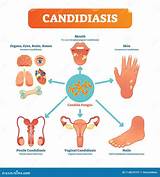 thrush medical Cheaper Than Retail Priceu003e Buy Clothing, Accessories and ...