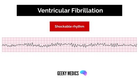 Shockable vs. Non-shockable Rhythms in Cardiac Arrest | Geeky Medics
