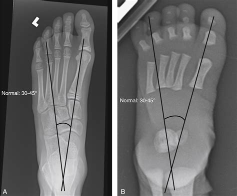 Approach to Pediatric Foot | Radiology Key