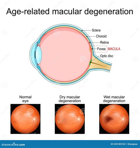 Age-related Macular Degeneration. Cross Section of Human Eye Stock Vector - Illustration of ...