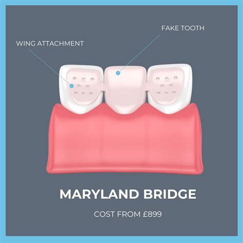 Dental Bridge Cost BEST Dental Bridges Royal Palm Beach FL Dental