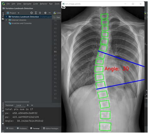 Automated Cobb Angle Measurement for Adolescent Idiopathic Scoliosis ...