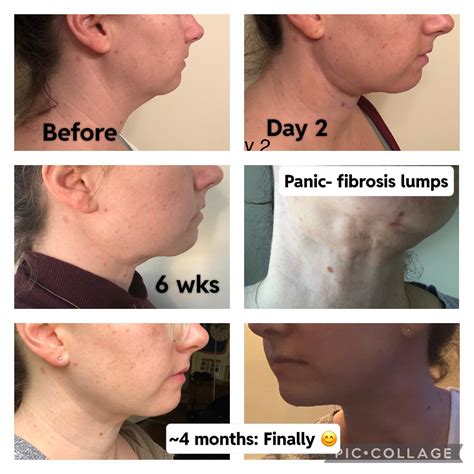 2 Week Post Op Neck Liposuction Recovery Photos Facial Liposuction