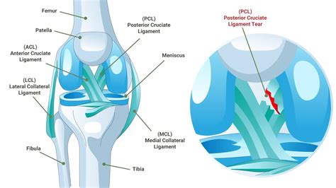 PCL Tear - Dr. Eric Giang