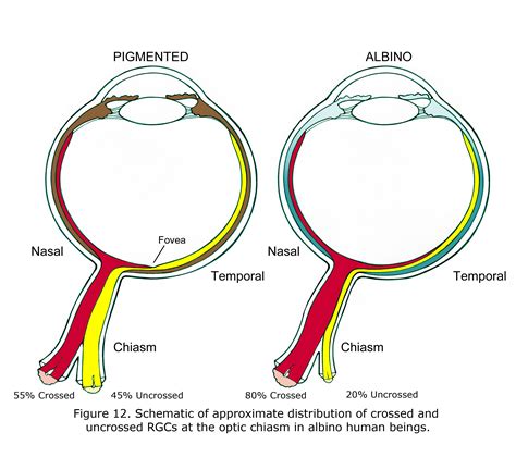 Ocular Albinism on emaze