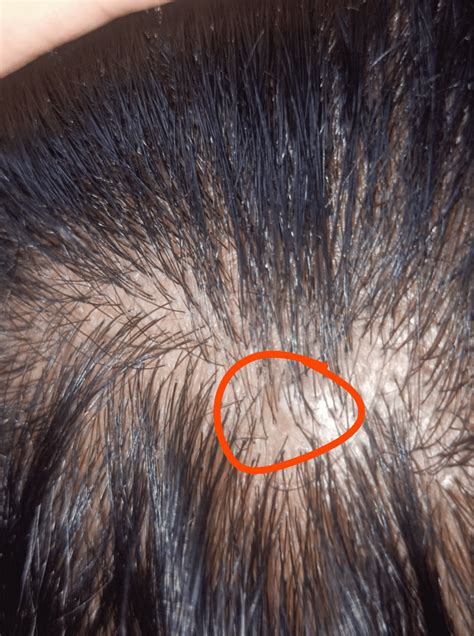 Acne on scalp : r/acne