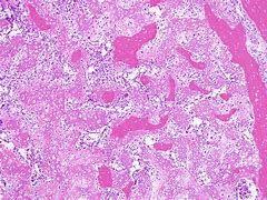 Osteosarcoma 的图像结果