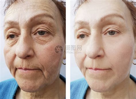 手术前后老妇人脸上的皱纹高清图片下载-正版图片505822783-摄图网