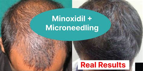The Synergistic Effects of Microneedling and Minoxidil for Hair Regrowth: A Comprehensive Guide ...