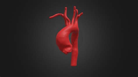 Aberrant Right Subclavian Artery - 3D model by yuhuihuang [df238bf ...