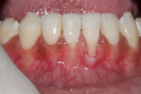 Tooth Recession 的图像结果