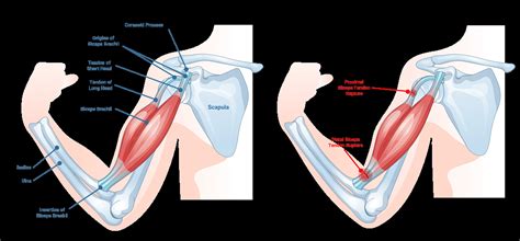 Bicep Tendon Rupture - Kyle McClintock, DO | Orthopedic Surgeon ...