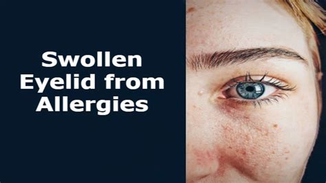 Allergy Eye Drops For Swollen Eyelids at Samuel Moysey blog