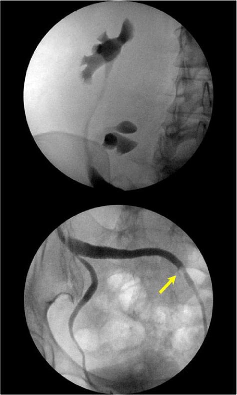 Image result for Retro Pyelogram Cystoscopy