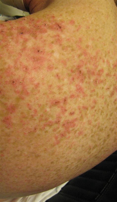 Lupus Rash: What It Is And How To Treat It GoodRx, 47% OFF