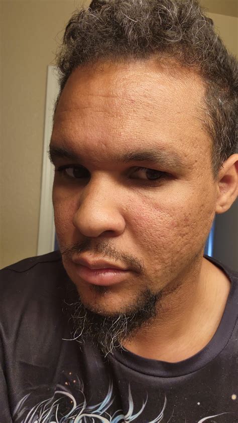 How to reduce pore size & pockmarks? : r/AcneScars