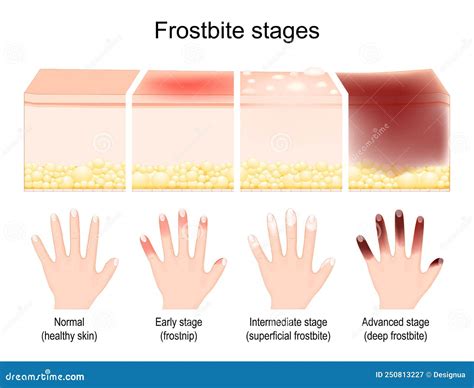 Frostbite Stages And Symptoms _ Frostbite: Stages, Symptoms, Pictures, Treatment & Recovery Time ...