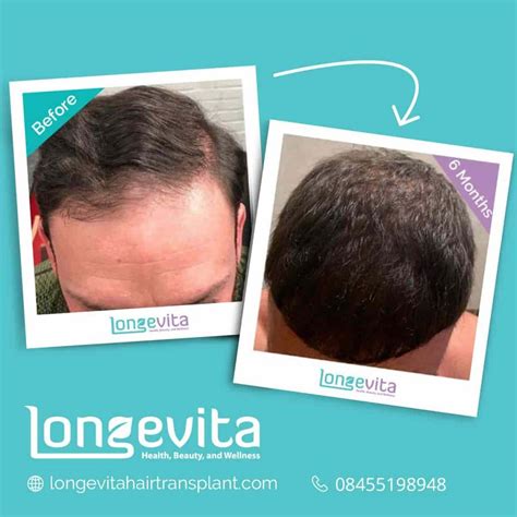 What Is The Hair Transplant Growth Chart? | Longevita