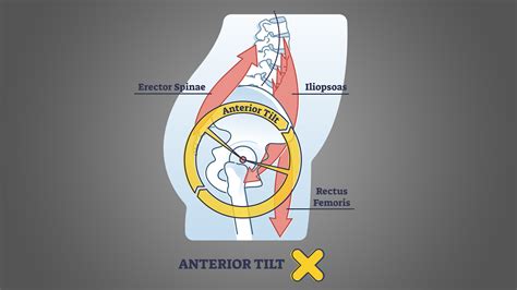 Anterior Pelvic Tilt: 3 Stretches and 3 Exercises to Remedy - Inspire US