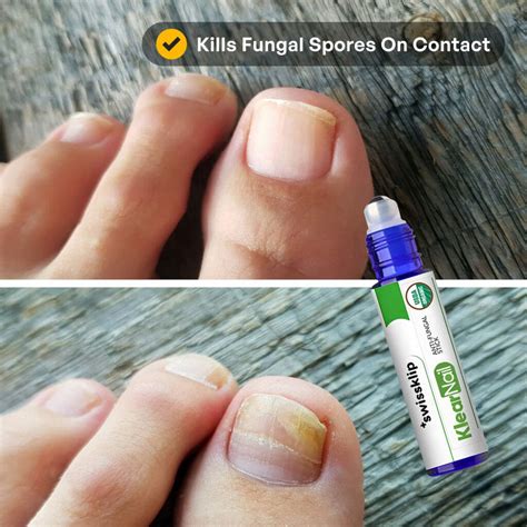 KlearNail Anti-Fungal Stick - Swissklip
