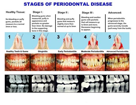 Gingival Index