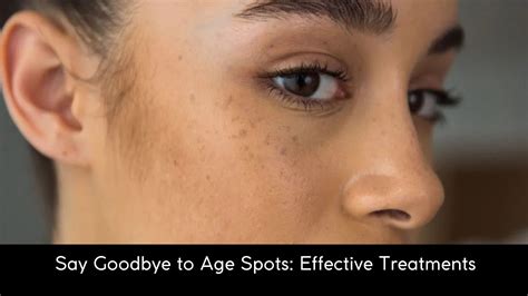 Say Goodbye to Age Spots: Effective Treatments